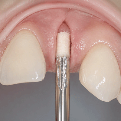 1carotta_apllication_zahnkl